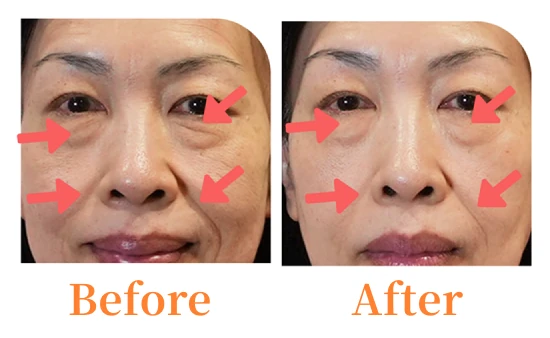 目元 Before / After