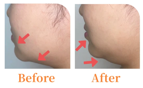 フェイスライン Before / After